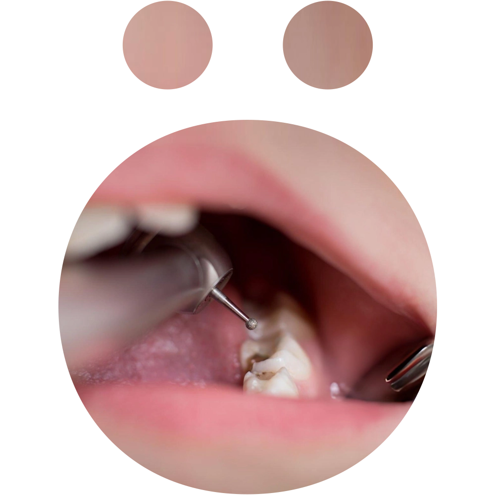 DEntal Fillings - Snö Clinics | Abu Dhabi