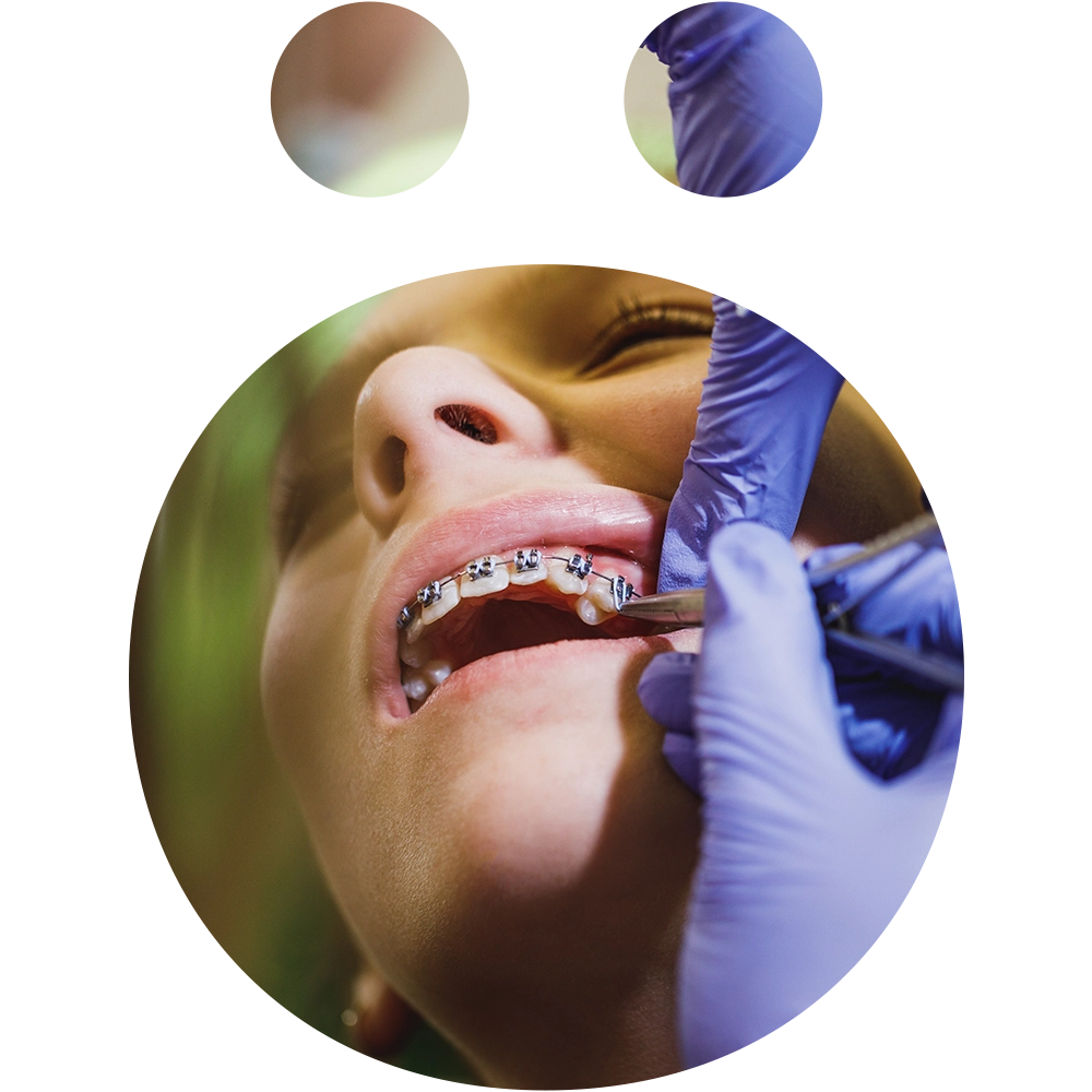 sno orthodontics - Snö Clinics | Abu Dhabi Thin wire fixed retainer bonded behind front teeth for long-term alignment.