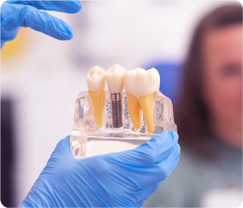 dental implant - Snö Clinics | Abu Dhabi