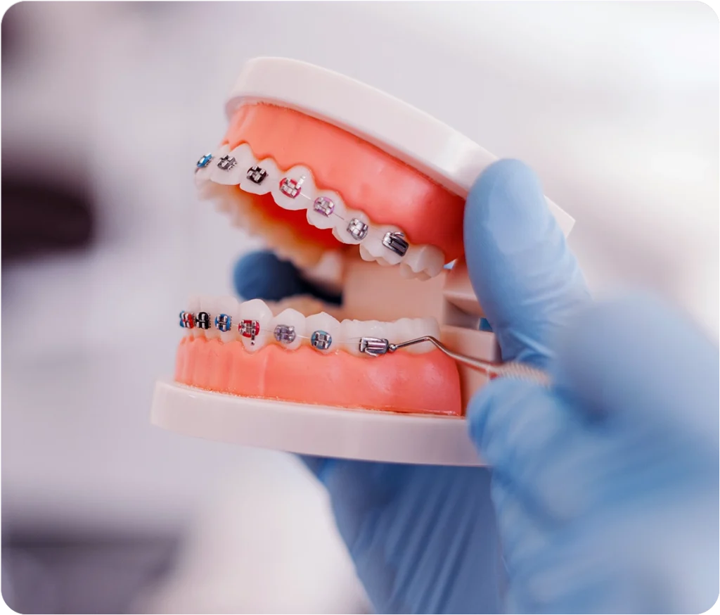 fixed braces - Snö Clinics | Abu Dhabi