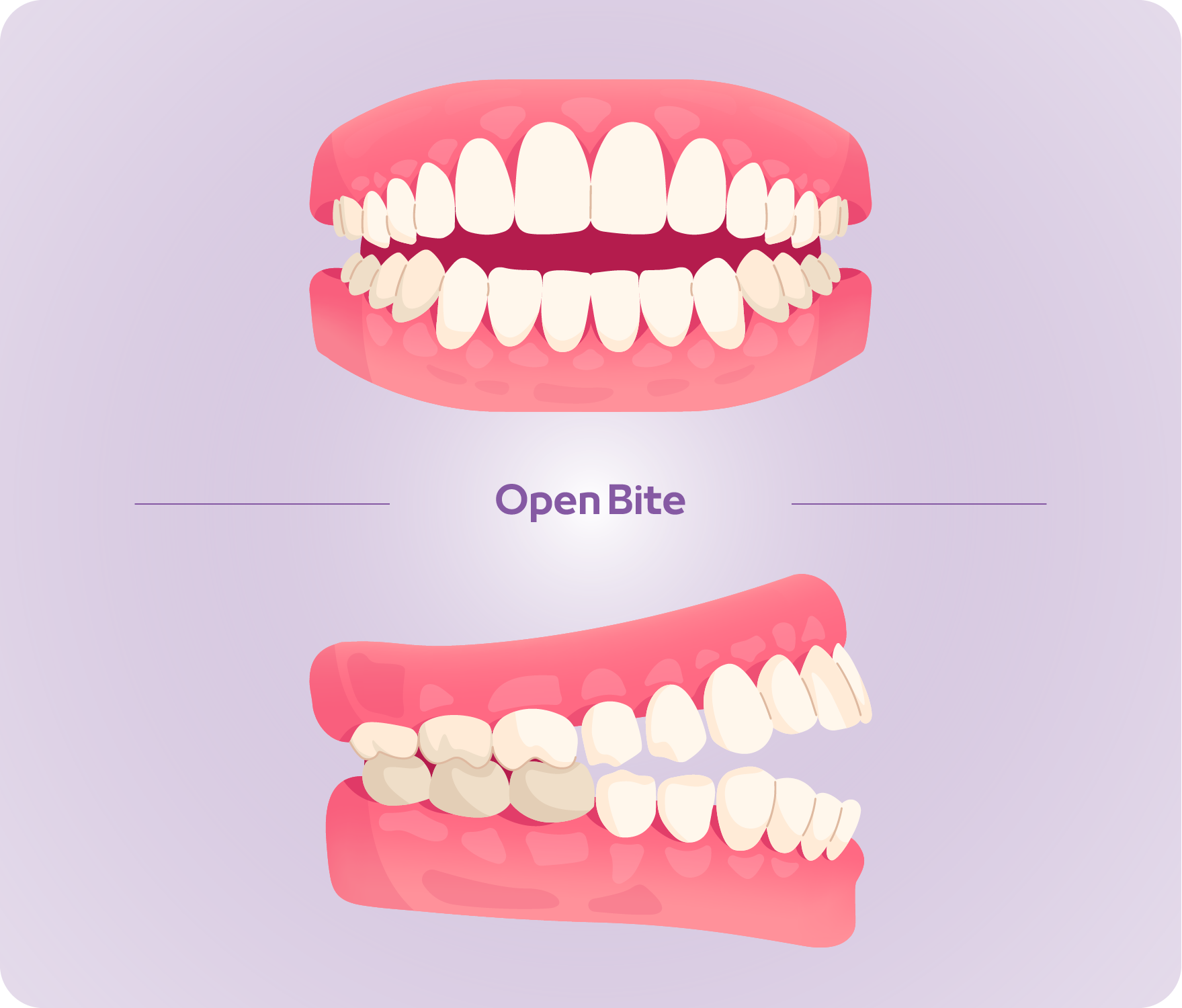 types of bite-01