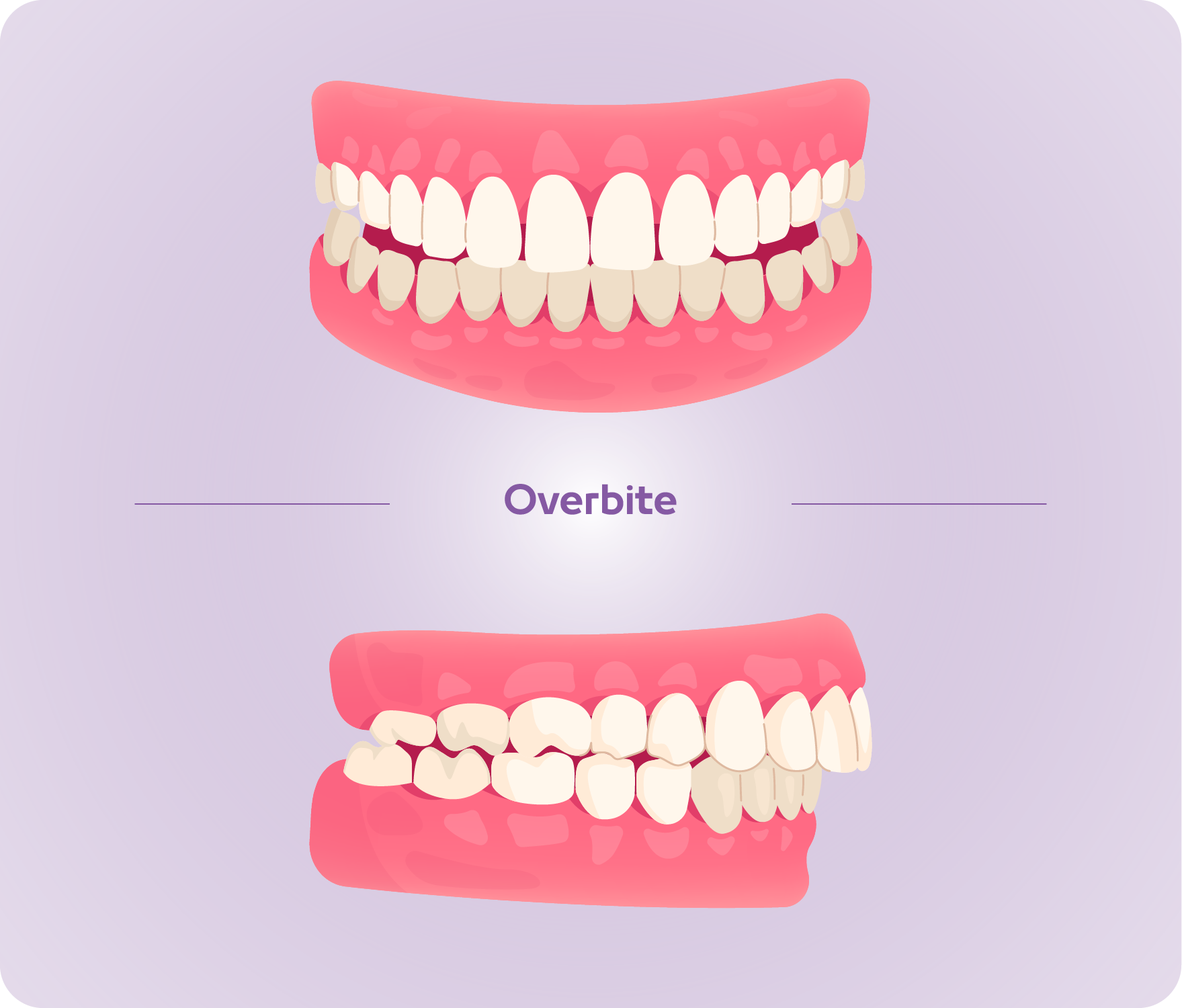 types of bite-02