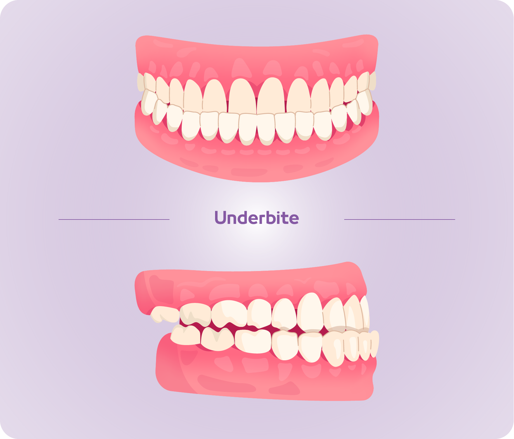 types of bite-05