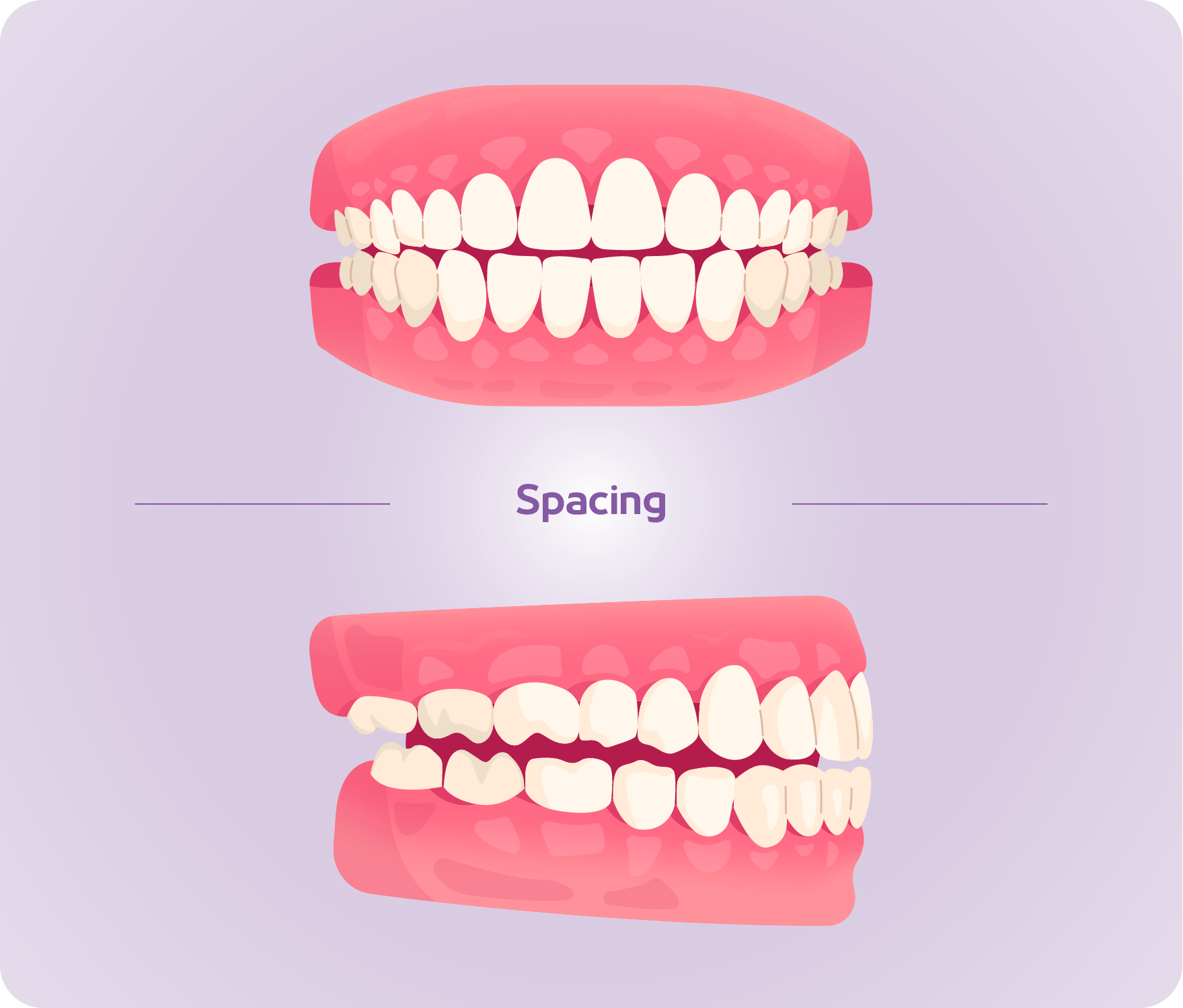 types of bite-06