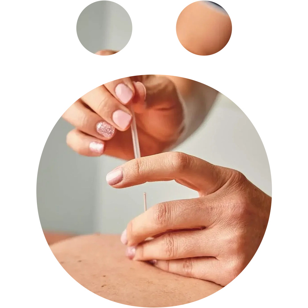 Close-up of acupuncture needles applied during physiotherapy at Snö Clinics Abu Dhabi to relieve pain and promote healing - Snö Clinics | Abu Dhabi Close-up of acupuncture needles applied during physiotherapy at Snö Clinics Abu Dhabi to relieve pain and promote healing.