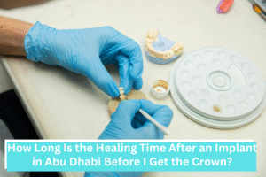 How Long Is the Healing Time After an Implant in Abu Dhabi Before I Get the Crown?