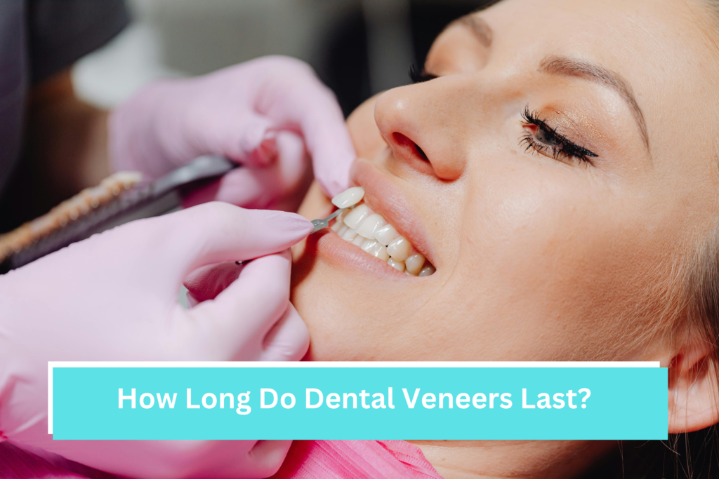 dental veneers