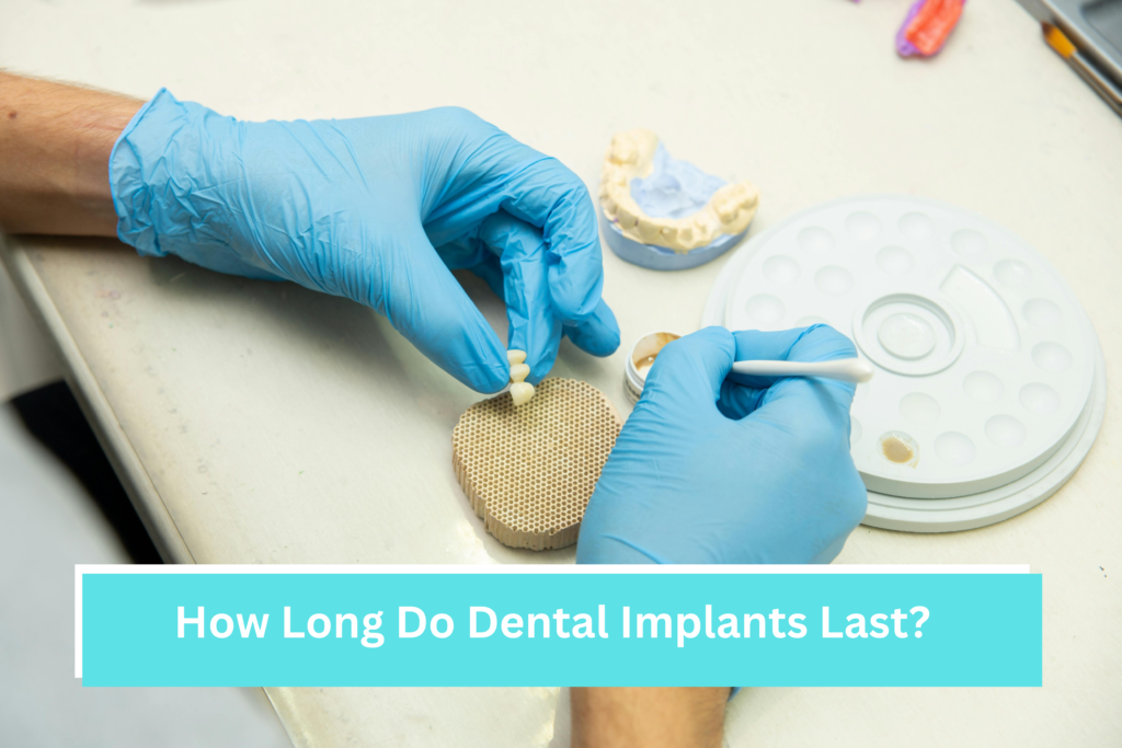 How Long Do Dental Implants Last?