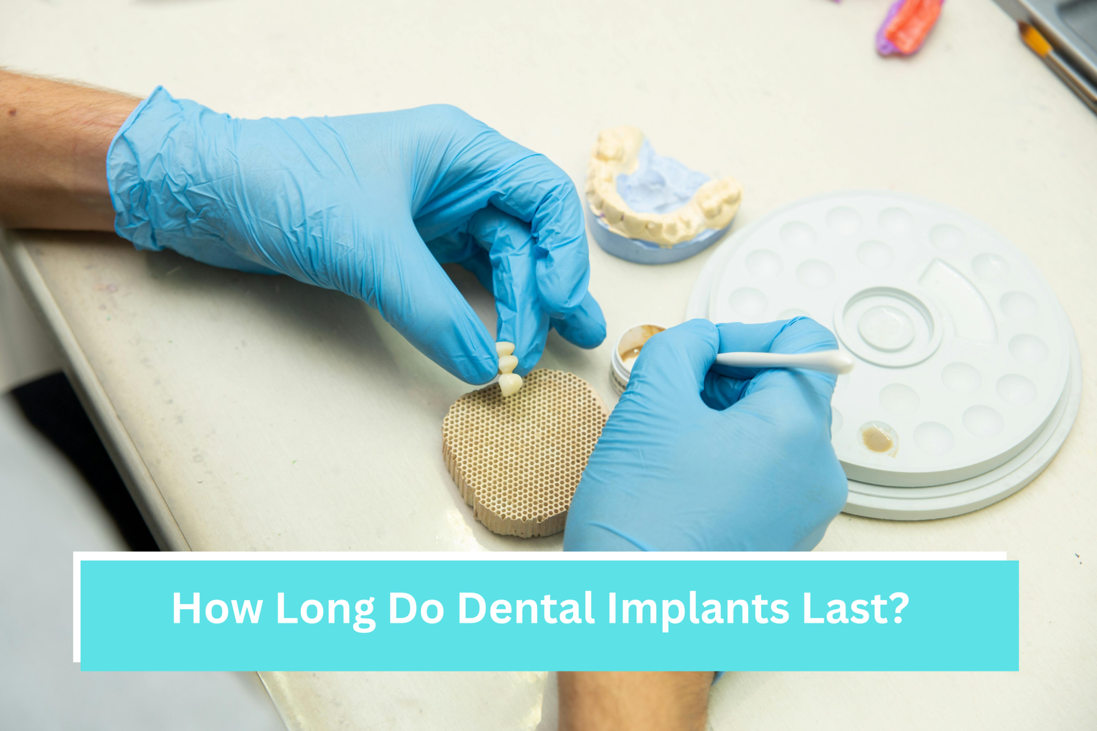 How Long Do Dental Implants Last?
