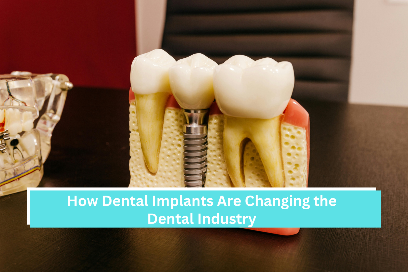How Dental Implants Are Changing the Dental Industry