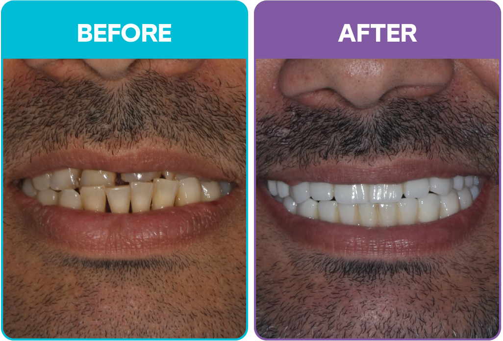 Aris - Before and after-01