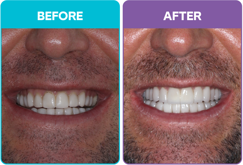 Aris - Before and after-02