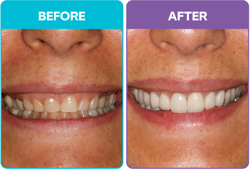 Aris - Before and after-03