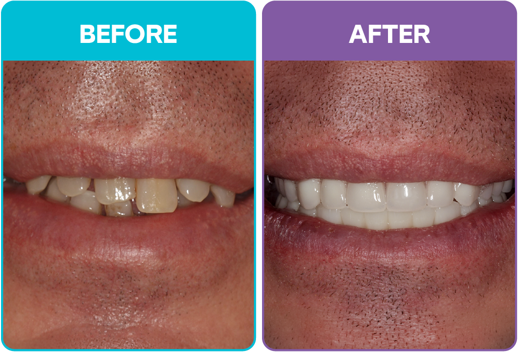 Aris - Before and after-04