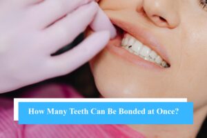 How Many Teeth Can You Bond in One Visit