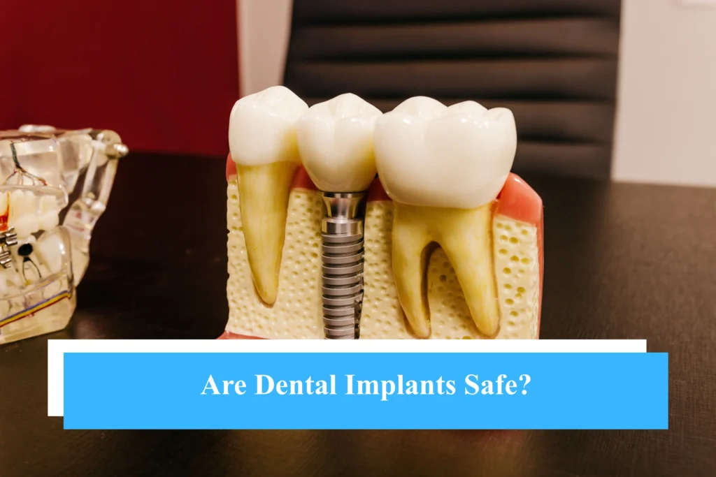Are Dental Implants Safe?