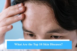 What Are the Top 10 Skin Diseases? - Snö Clinics | Abu Dhabi - Snö Clinics | Abu Dhabi What Are the Top 10 Skin Diseases?